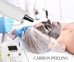 carbon peeling